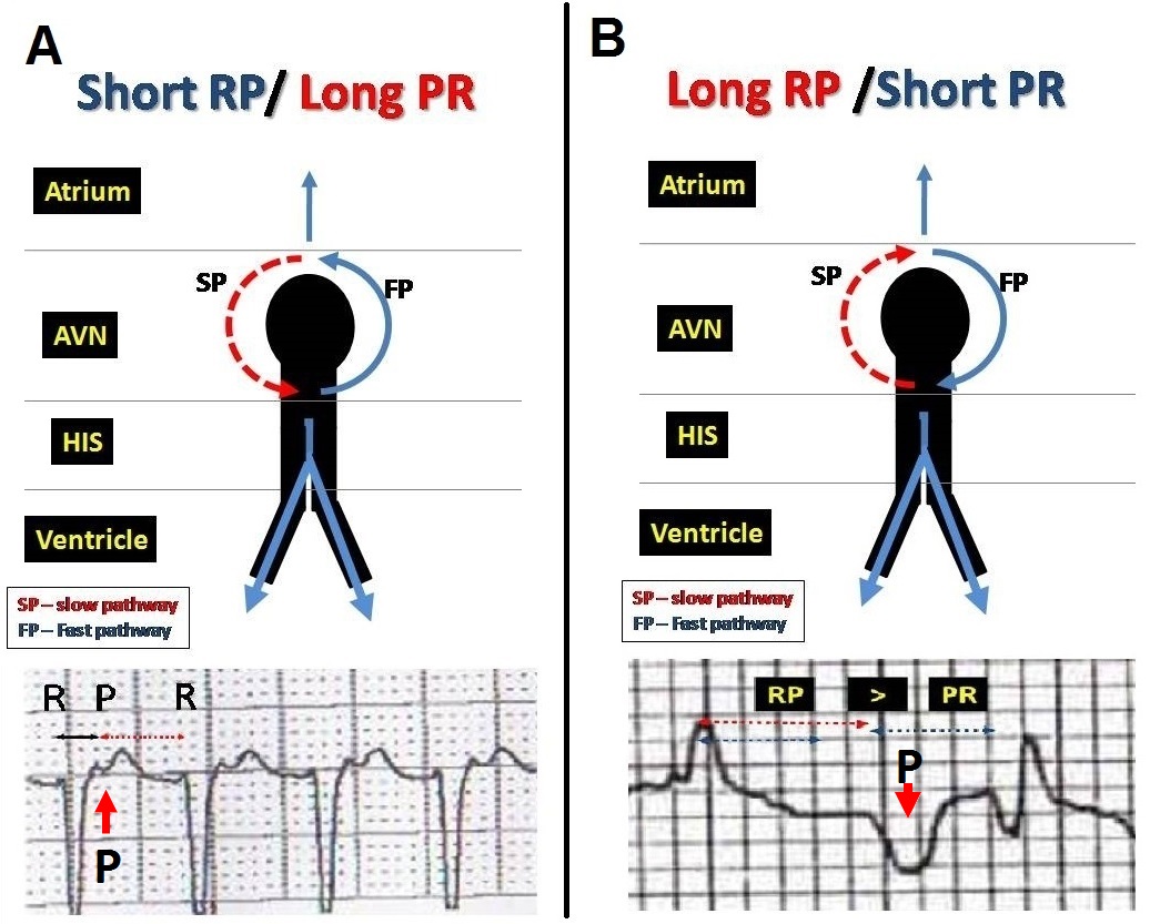 ECG Rhythms The effect of a spontaneous PVC in a supraventricular