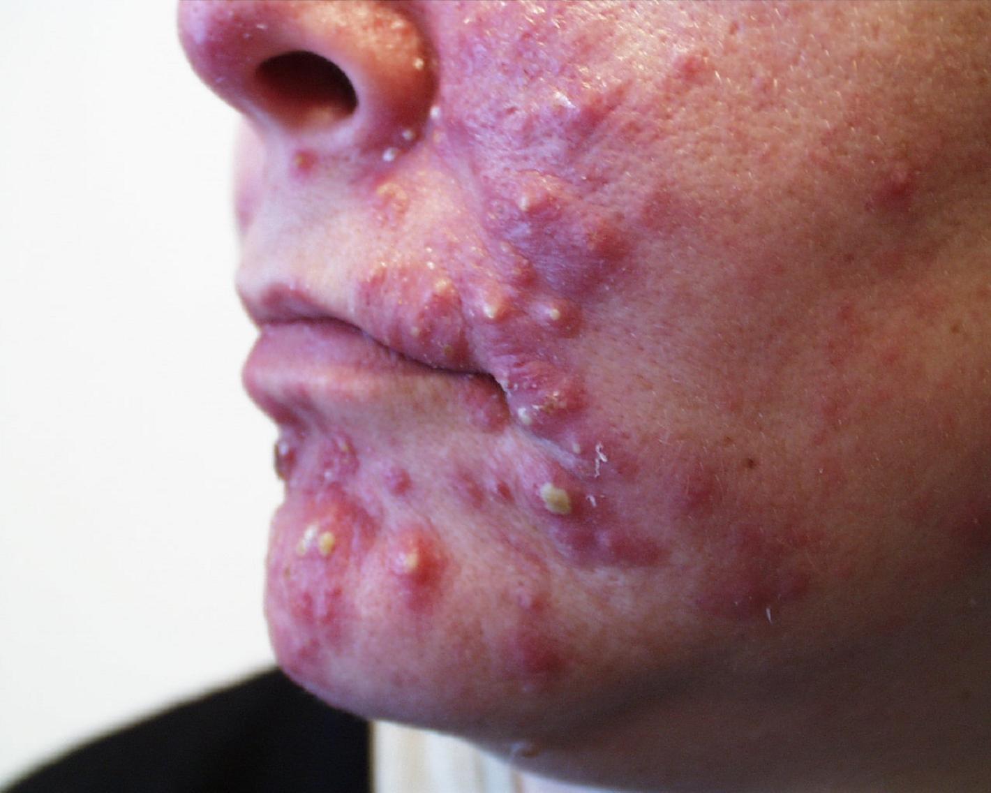 Severe acne popping
