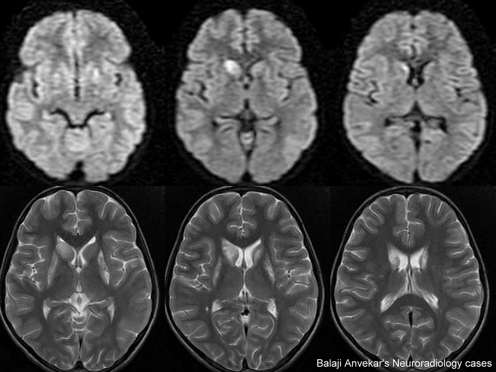 Dr Balaji Anvekar FRCR Leigh's MR Spectroscopy