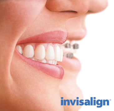 brackets invisibles brackets invisibles