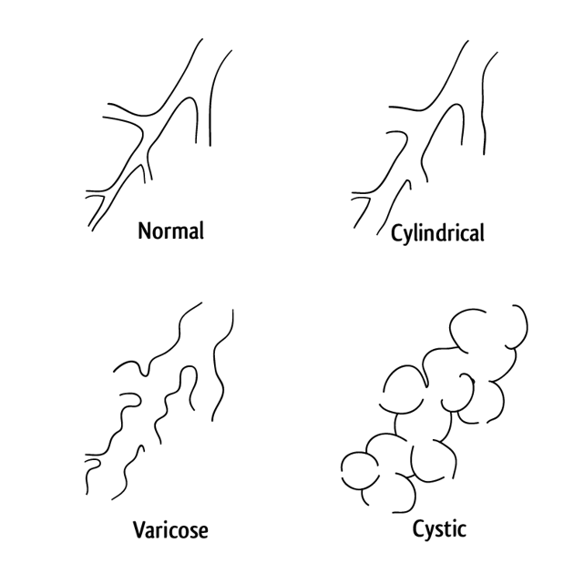 signet ring sign bronchiectasis