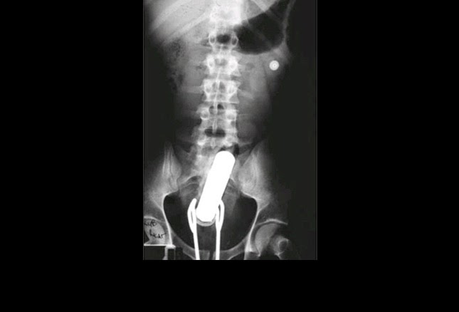 Доктор Вставляет Вибратор В Попу Молодого Парня