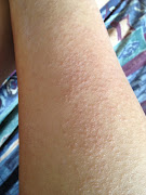 But I'm glad the rashes are getting better, still feel a little bit itchy at .
