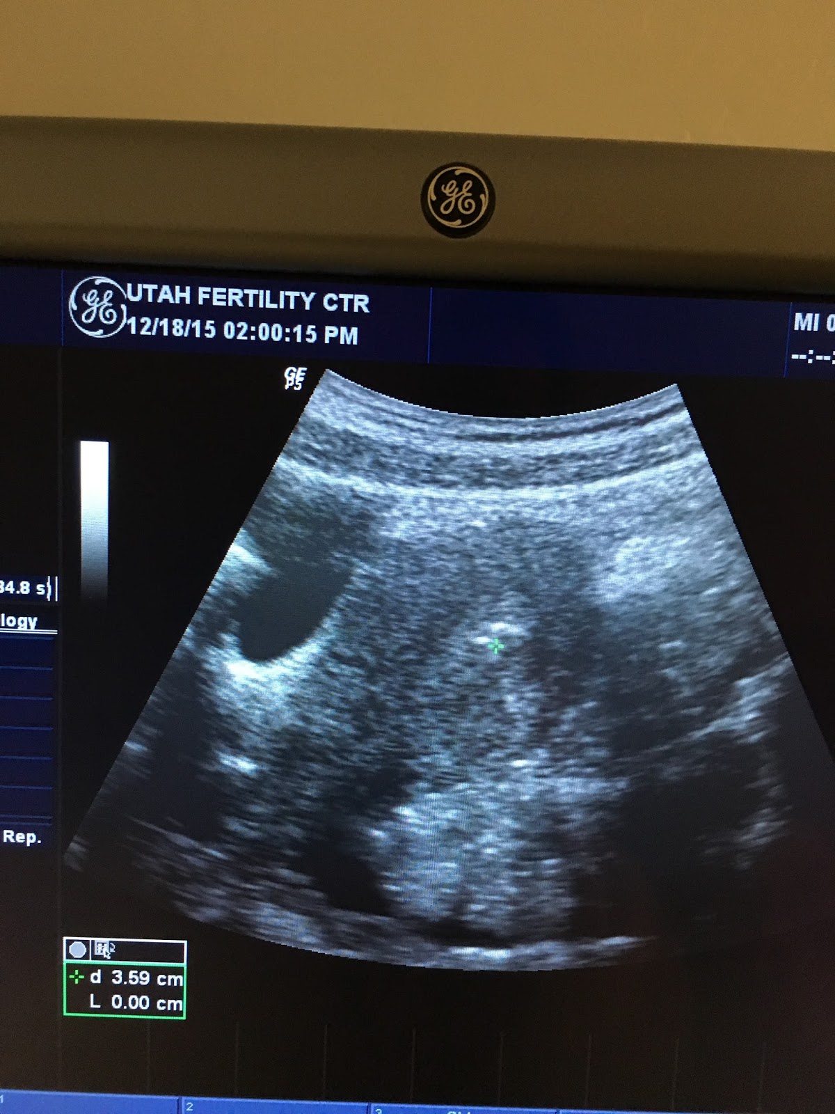 To My Beautiful Child Frozen Embryo Transfer! A Slice of Style