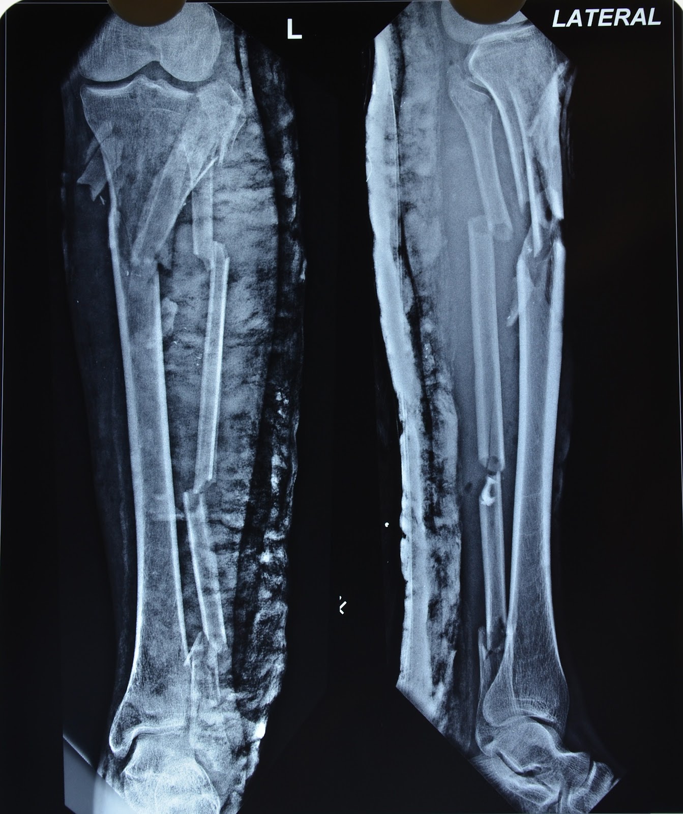 MAJOR CRUSH INJURY LEG WE TRIED BUT LATER DECIDED NOT TO SALVAGE