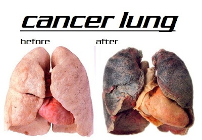  lung cancer image |image lung cancer before |image lung cancer after | adenocarcinomas lung image | lung of cancer 