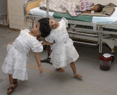http://3.bp.blogspot.com/-90QpiUP2-T0/T_tL6ibgGzI/AAAAAAAAKKg/G0OS7MwMHqI/s1600/conjoined+twin+2.jpg