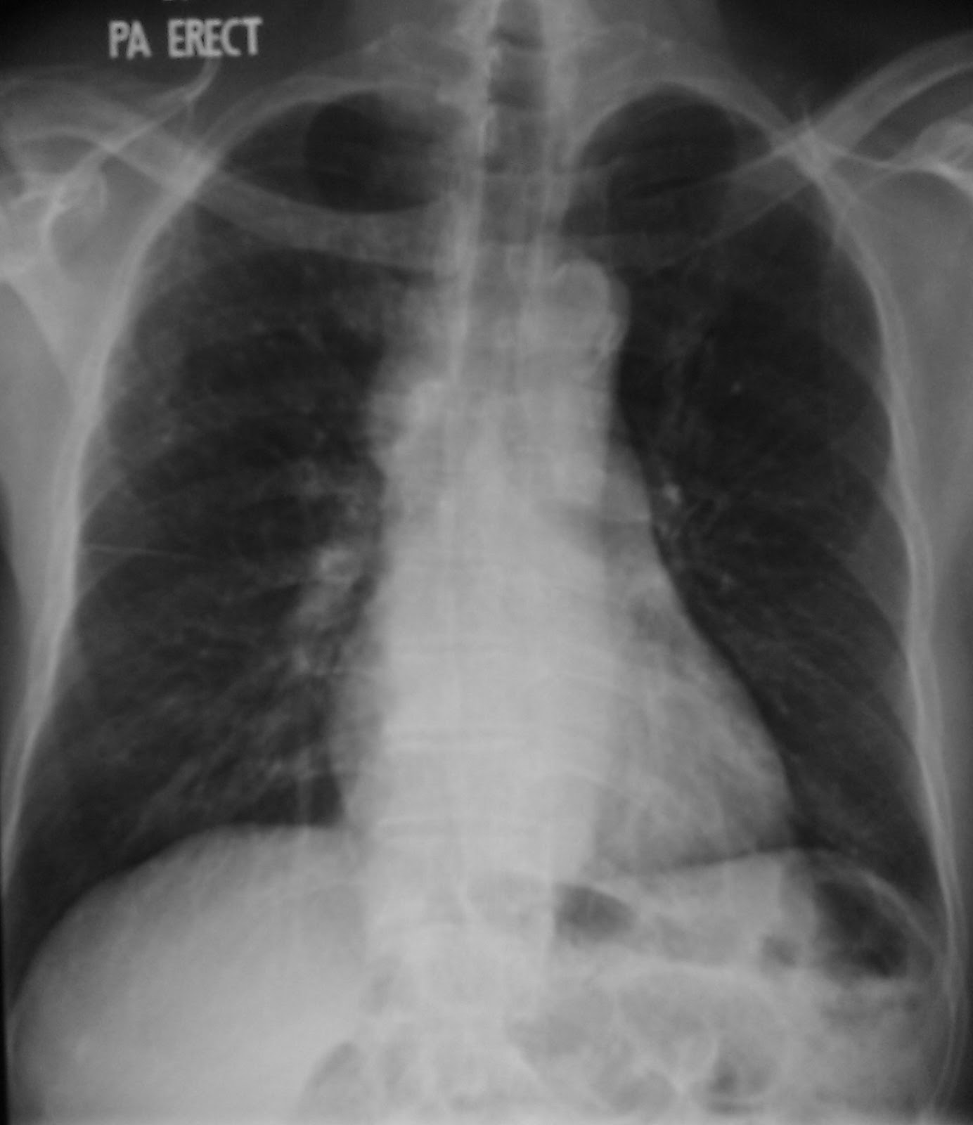 Learning Chest Radiology Case 363 Thymic carcinoma