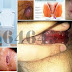 Jual Online Obat Wasir Ambeclear Isi 50Kapsul thumbnail