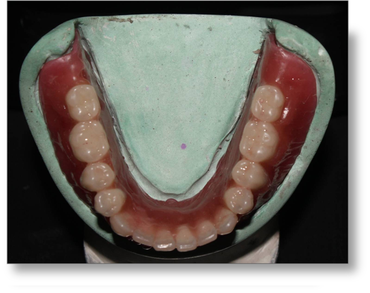 Step by step Guide for Understanding the Prosthodontics Complete