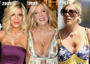 Tori Spelling Breast Implants Before & After
