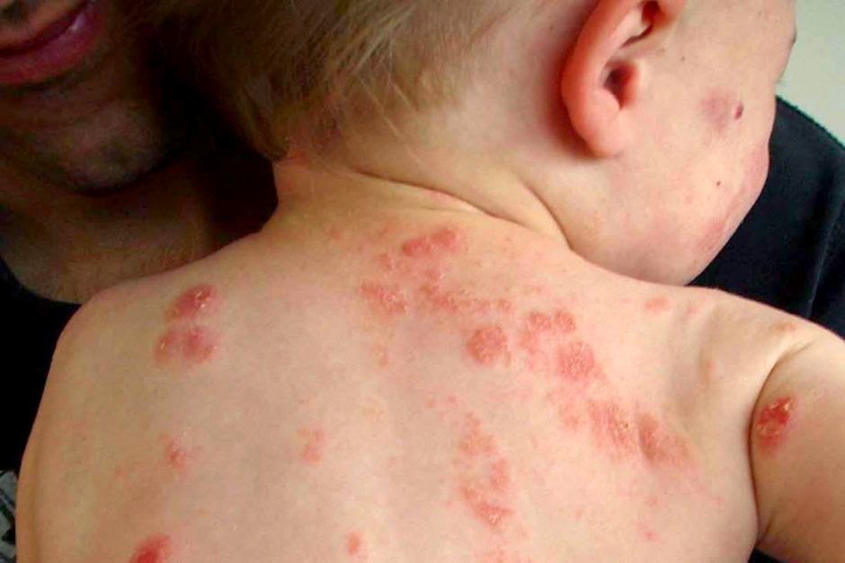 TVINE Keeping your eczema and psoriasis under control