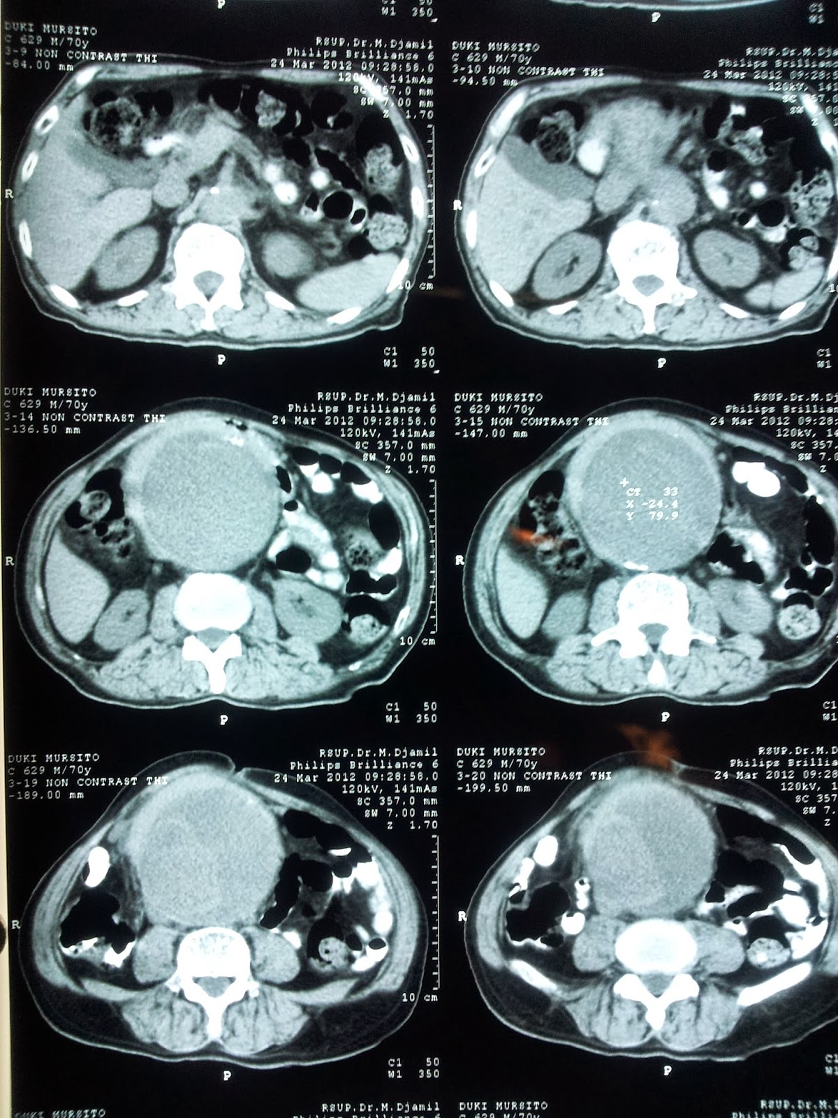 Spesialis Bedah Vaskular dan Endovaskular: Aneurisma Aorta Spesialis Bedah Vaskular dan Endovaskular: Aneurisma Aorta