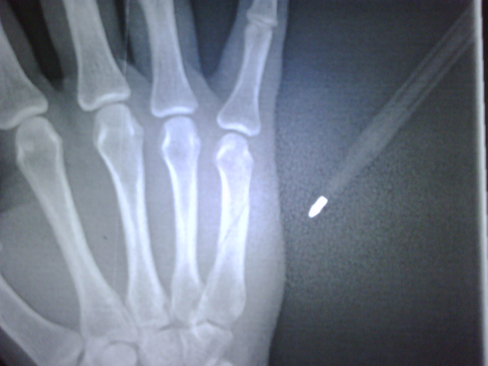 hand broken