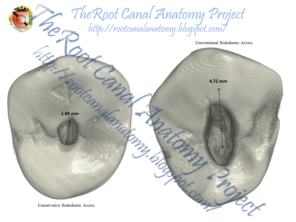 The Root Canal Anatomy Project: Conservative Endodontic Access