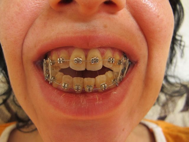 elastics chain power bite open openbite position initial july
