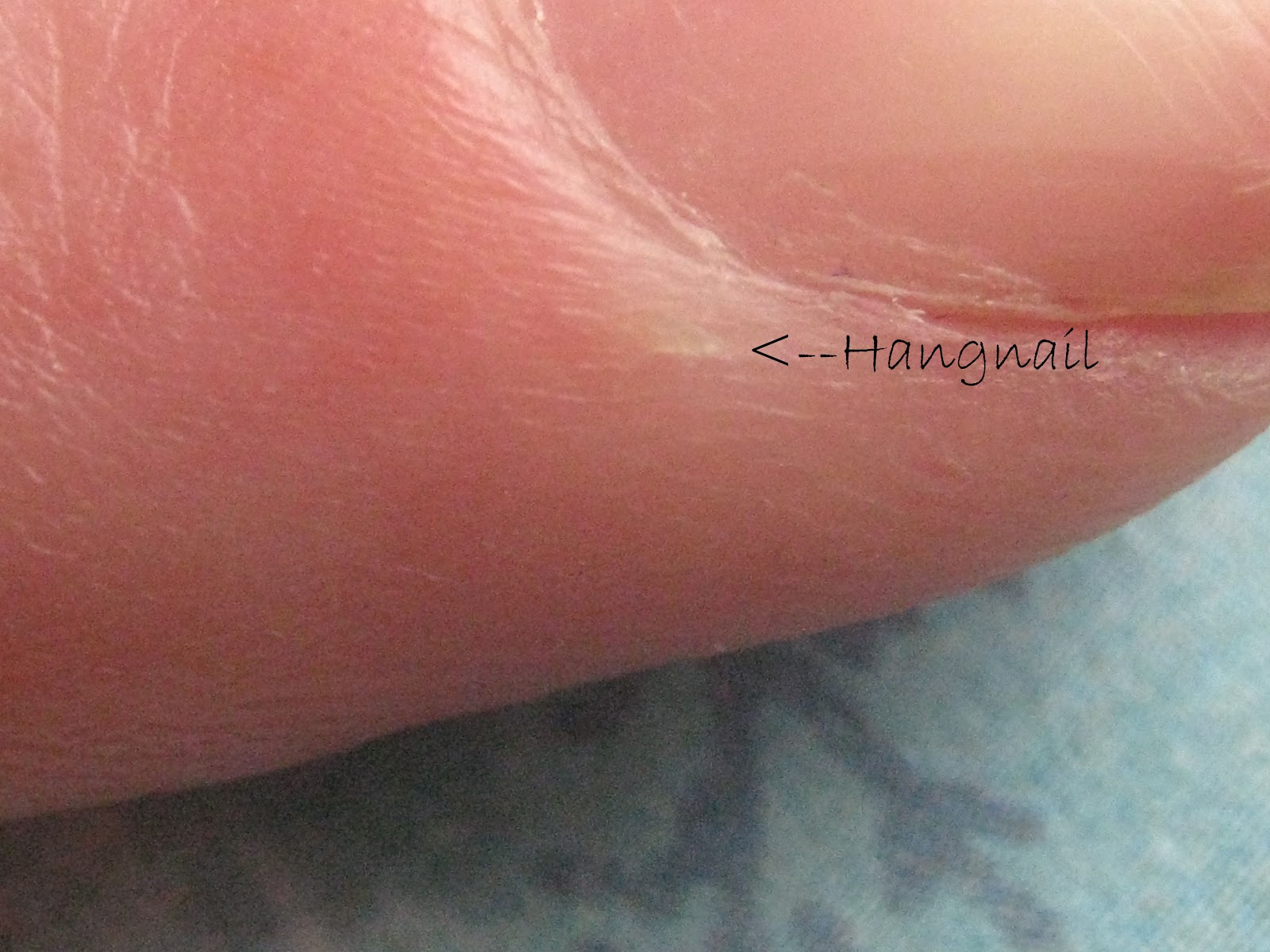 Rehab Your Nails What's a hangnail? Bee Polished