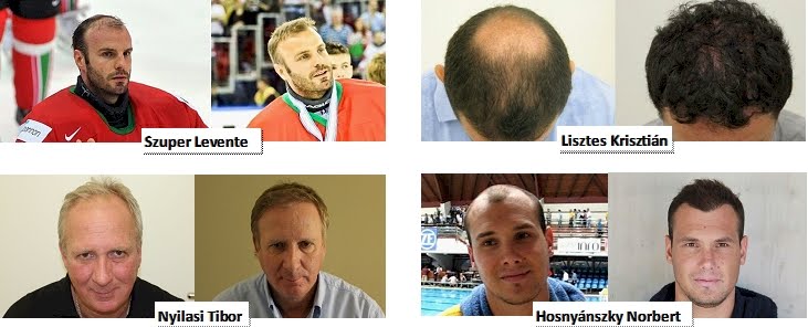 Hajátültetés képek