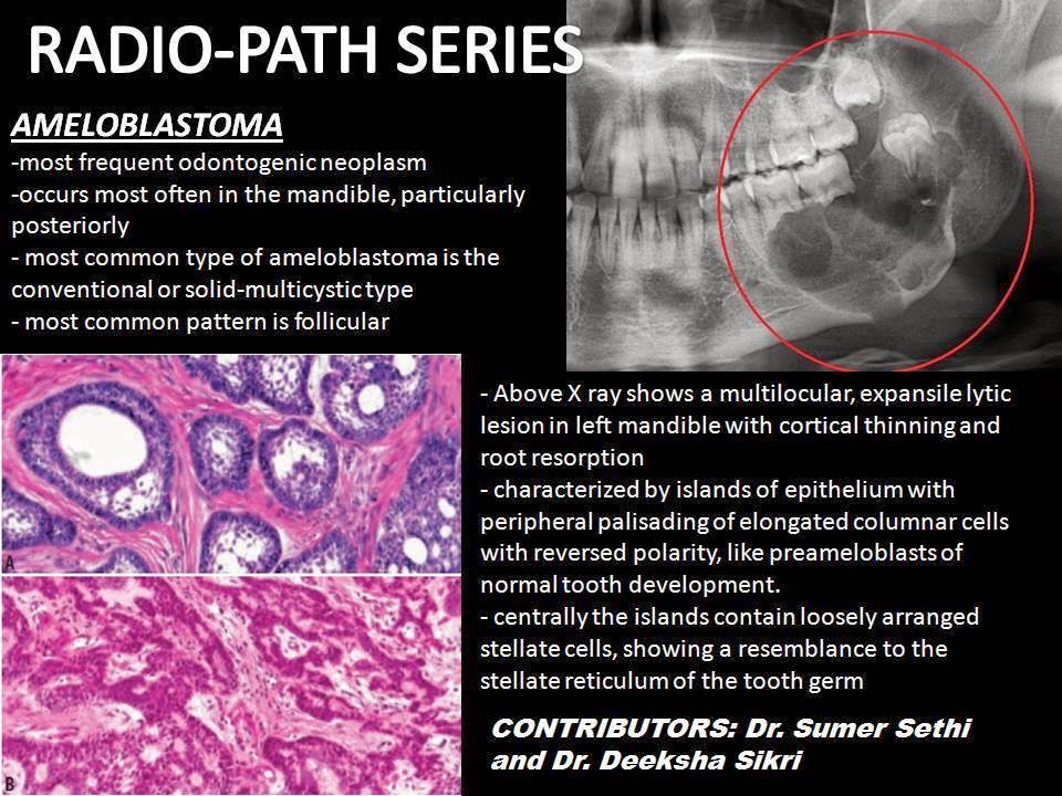 AmeloblastomaRadioPath Series Sumer's Radiology Blog