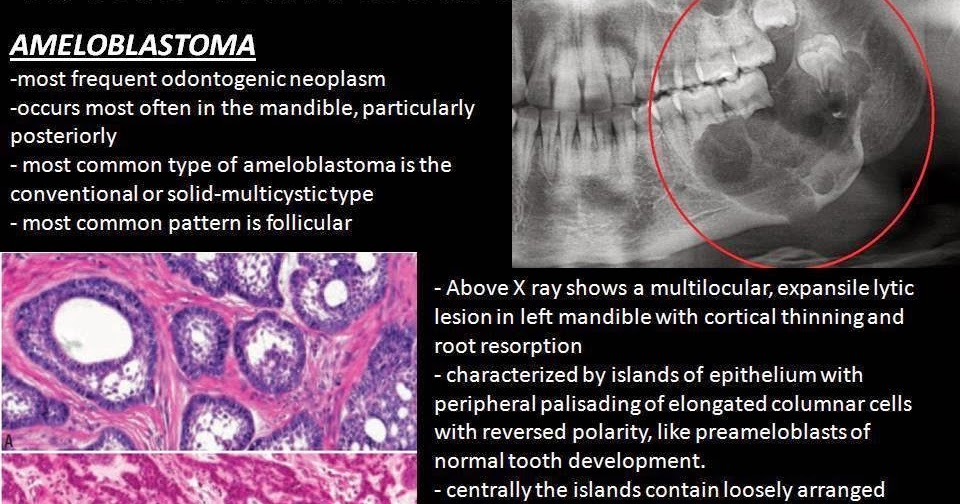 AmeloblastomaRadioPath Series Sumer's Radiology Blog