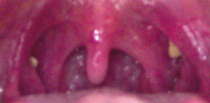 How To Get Rid Of Tonsil Stones For Good : Tonsillectomy For Tonsil Stones