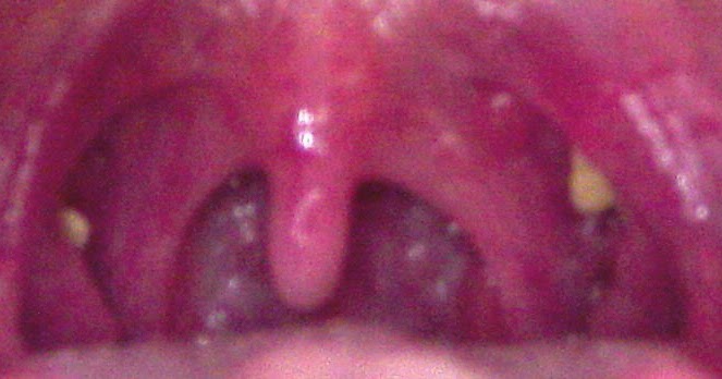 Chronic Tonsils Infection : Tonsil Stones - The ...