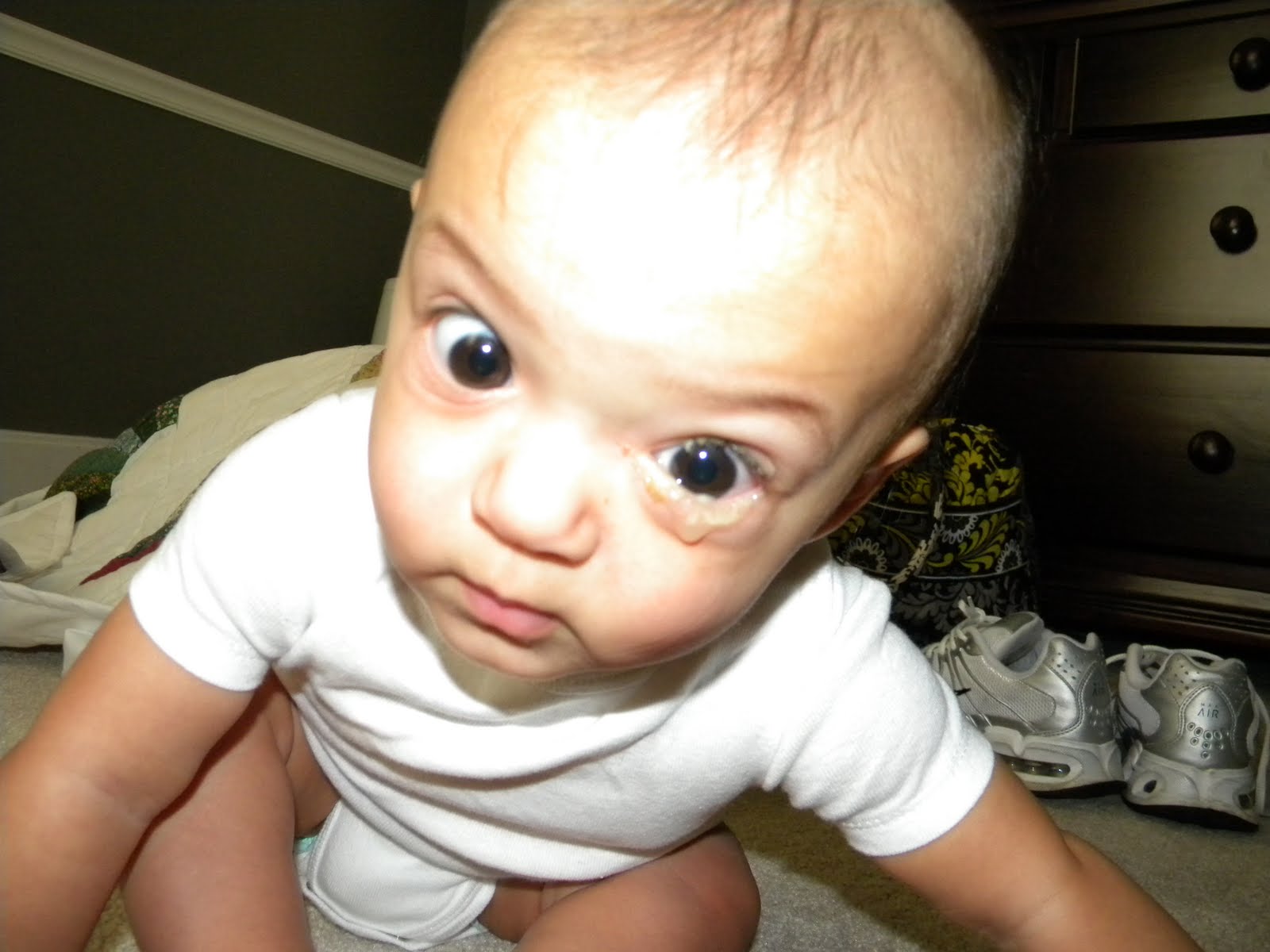 I Wake Up With My Eye Matted Shut at Barbara Allen blog