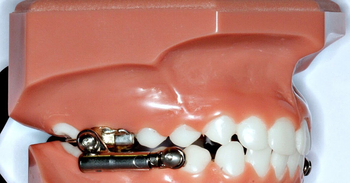 Smile Team Orthodontics What is a Jaw Corrector (Herbst Appliance) and