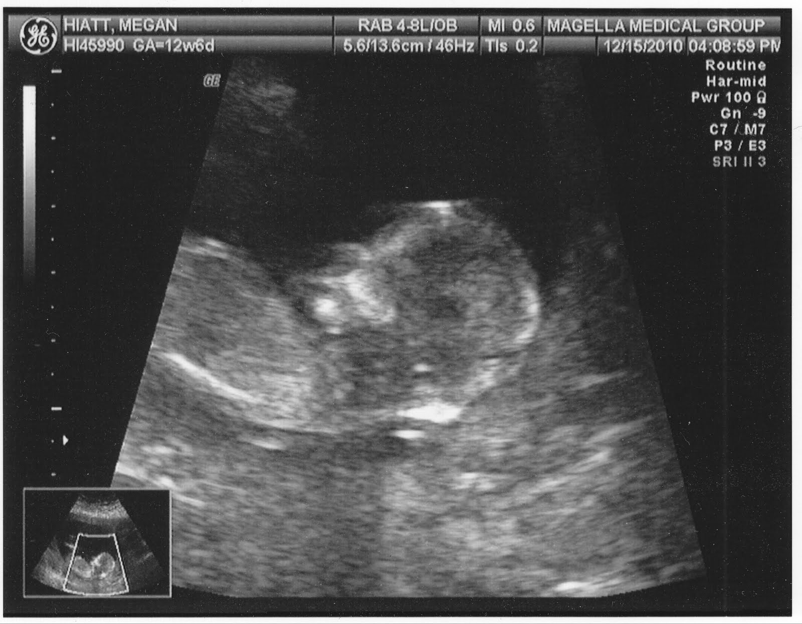 The Spamdrew Family: 13 Week Ultrasound