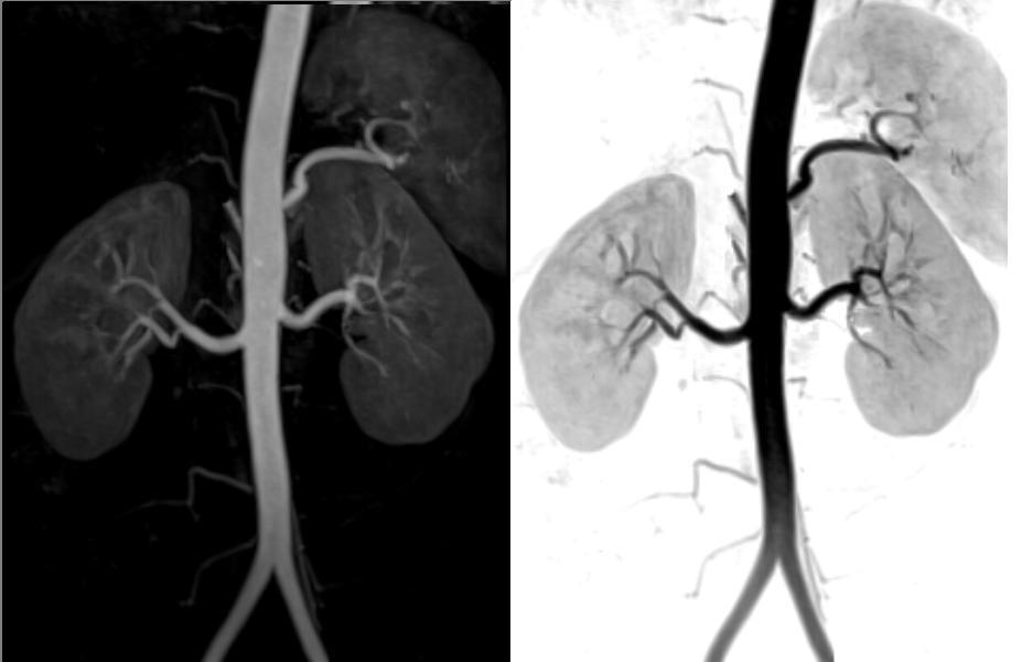 ct renal angiography procedure