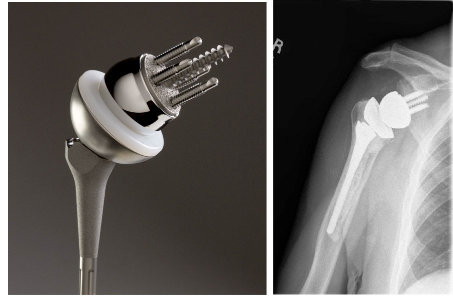 Shoulder Arthritis / Rotator Cuff Tears causes of shoulder pain Reverse Total Shoulder for