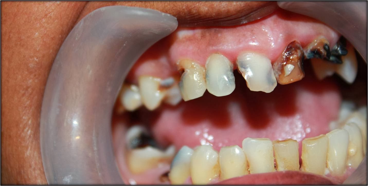 Front teeth dental implant cost in india