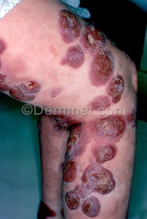 lymphosarcoma in dogs