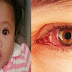 Conjunctivitis (Red Eye) Treatment & Management