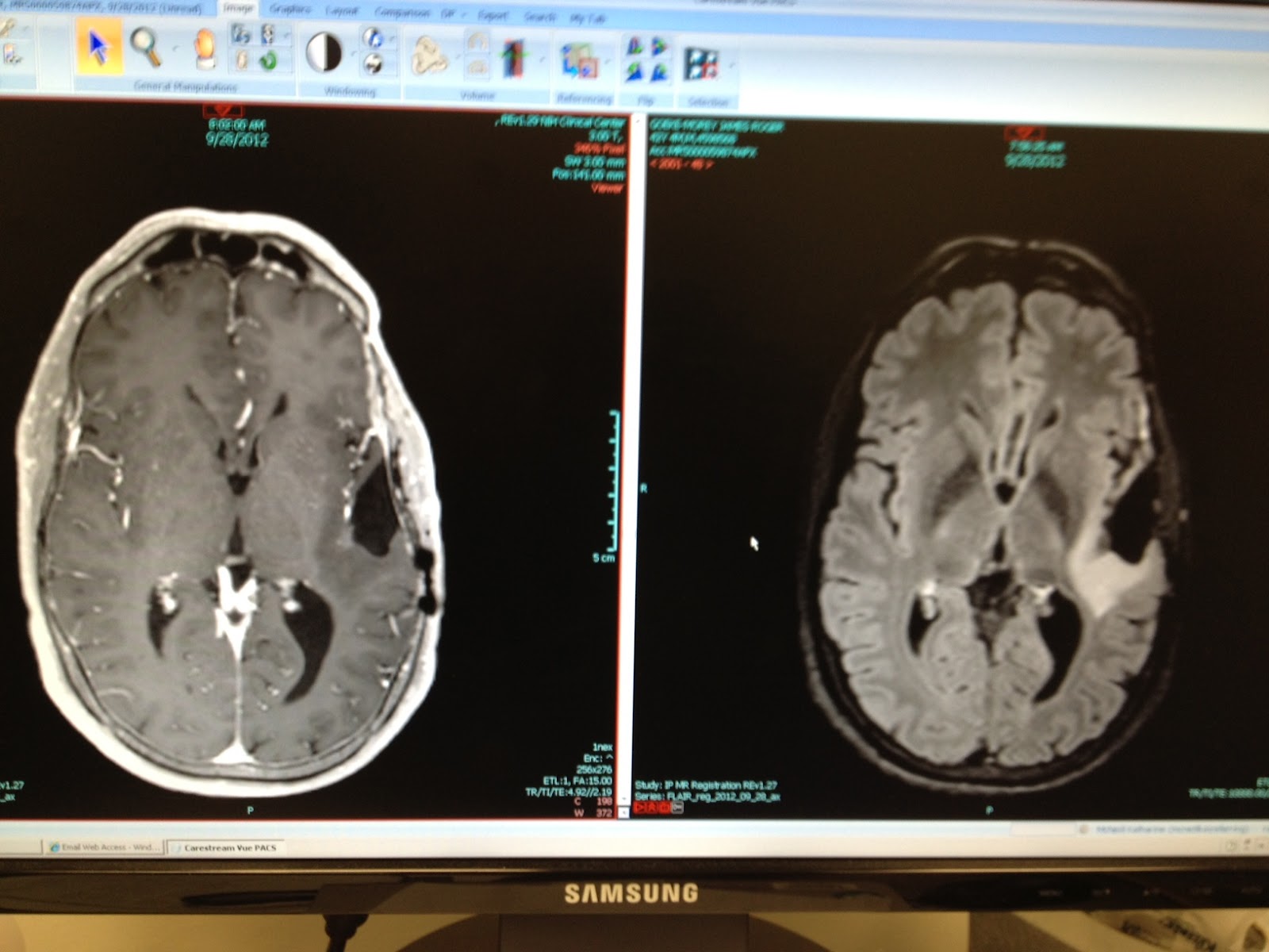 The Golf Ball in My Brain 2012