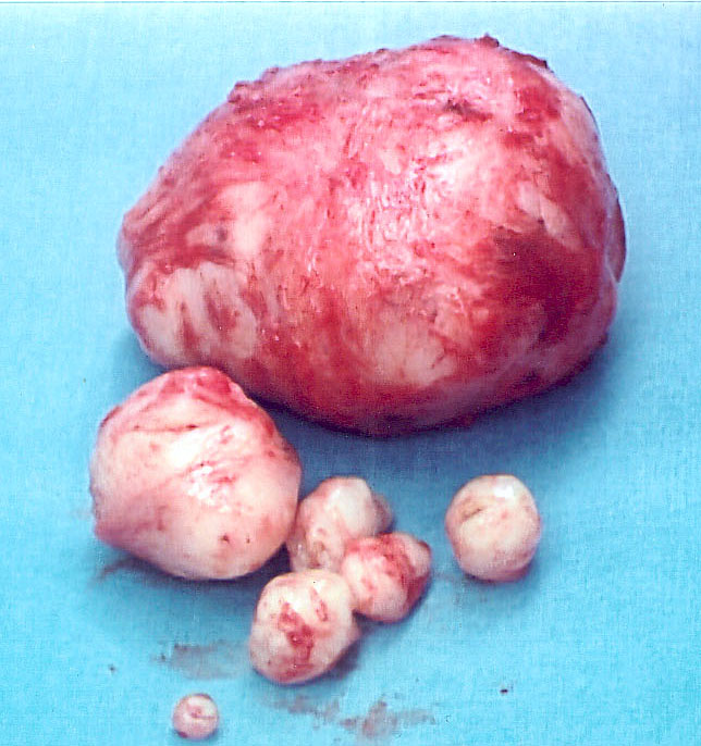 Fibroid Tumors Pictures