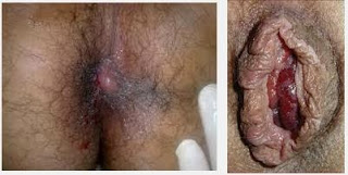 Obat Wasir Kaskus Obat Wasir Kaskus
