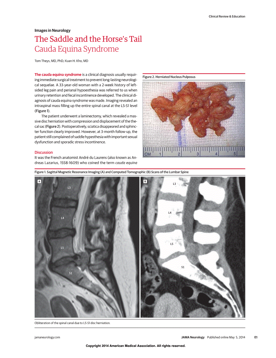 Clinical Neurology The Saddle and the Horse’s Tail Cauda Equina Syndrome