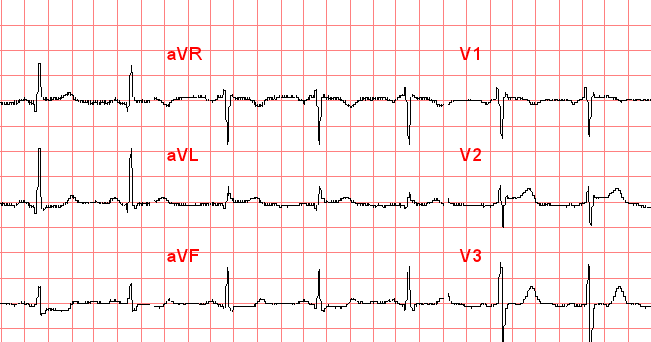 Dr. Smith's ECG Blog: STEMI: Which coronary artery is occluded?