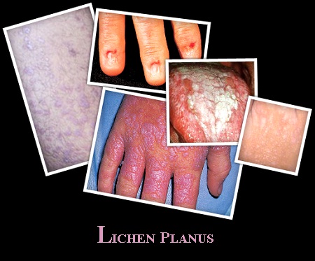 Lichen planus oral steroid treatment