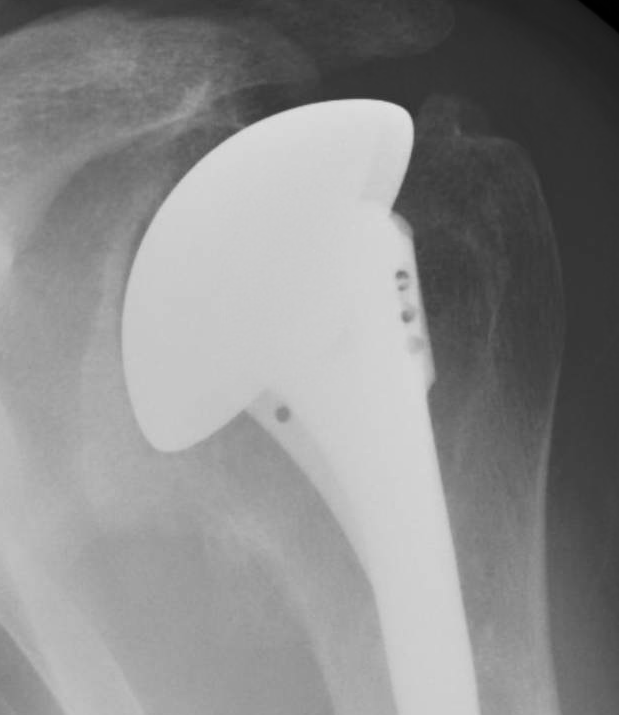 Shoulder Arthritis / Rotator Cuff Tears causes of shoulder pain "be