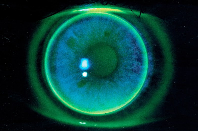 All things eye Por Yong Ming Keratoconusa conical corneal conundrum