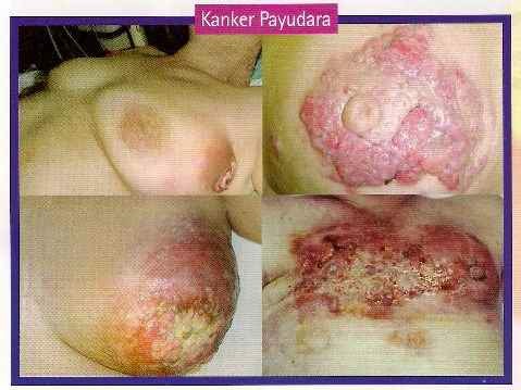 Penyakit Kanker Payudara Penyakit Kanker Payudara
