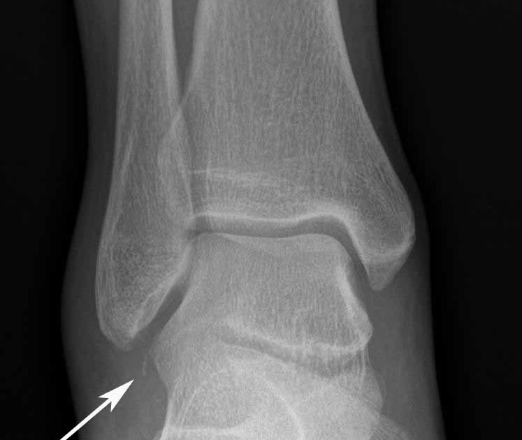 RiT radiology Fracture of the Lateral Process of Talus