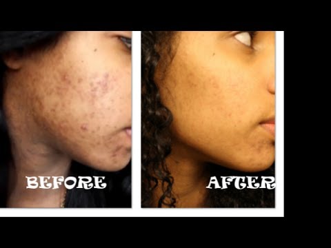 Is Drinking Green Tea Good For Acne Prone Skin Is Drinking Green Tea Good For Acne Prone Skin