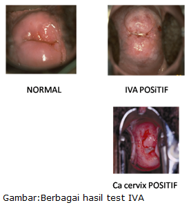 obgynmag: PEMERIKSAAN IVA TEST (Inspeksi Visual dengan Asam Asetat)