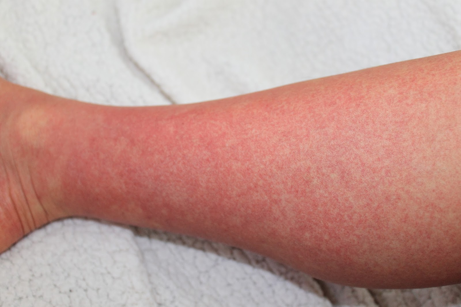 Fit &amp; Clean KRANKENHAUSAUFENTHALT Dengue Fieber