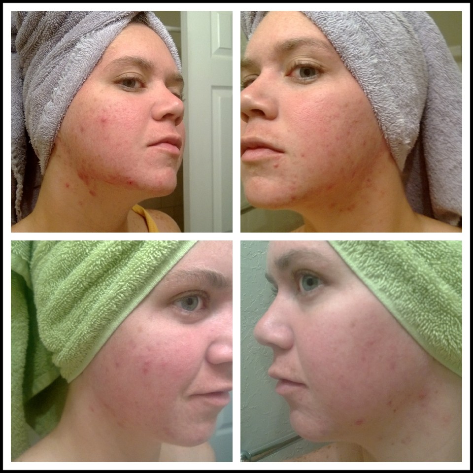 SWOK Happy, Healthy, and Fit Acne and Weight Loss Results