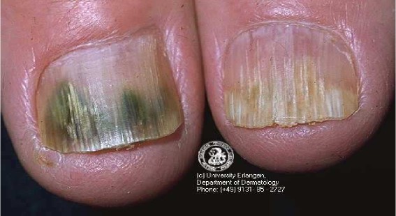 Causes of Fingernail Ridges