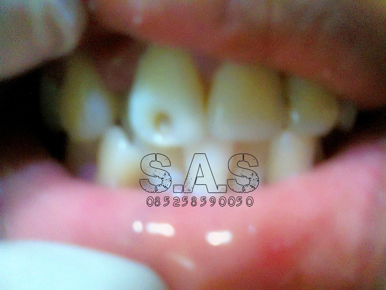 Cara Mengatasi Gigi Depan yang Hitam Menjadi Putih Kembali ...